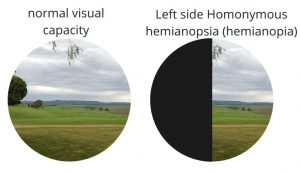 visual loss with left side hemiopia